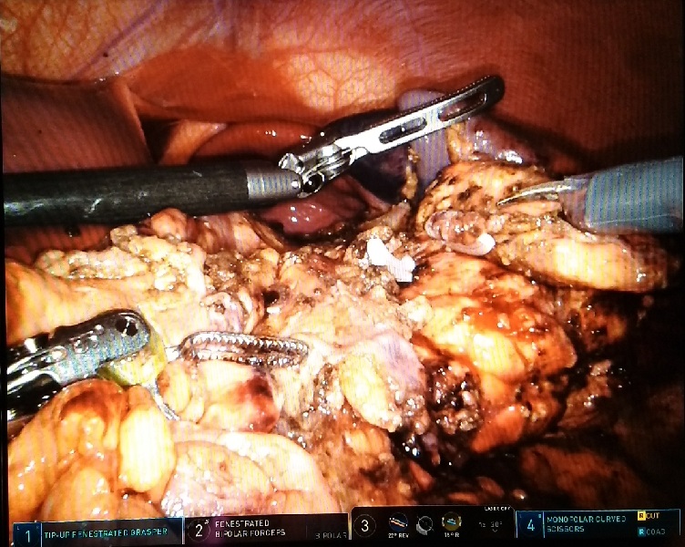 Before Distal Pancreatectomy
