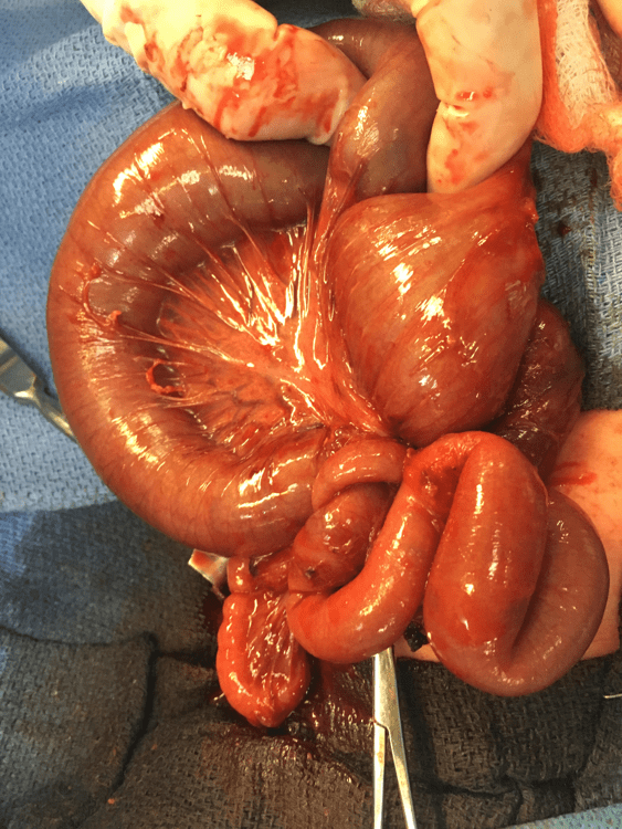 Image 5b: Operative photo depicting a Type IIIb intestinal atresia with an internal hernia through a mesenteric defect