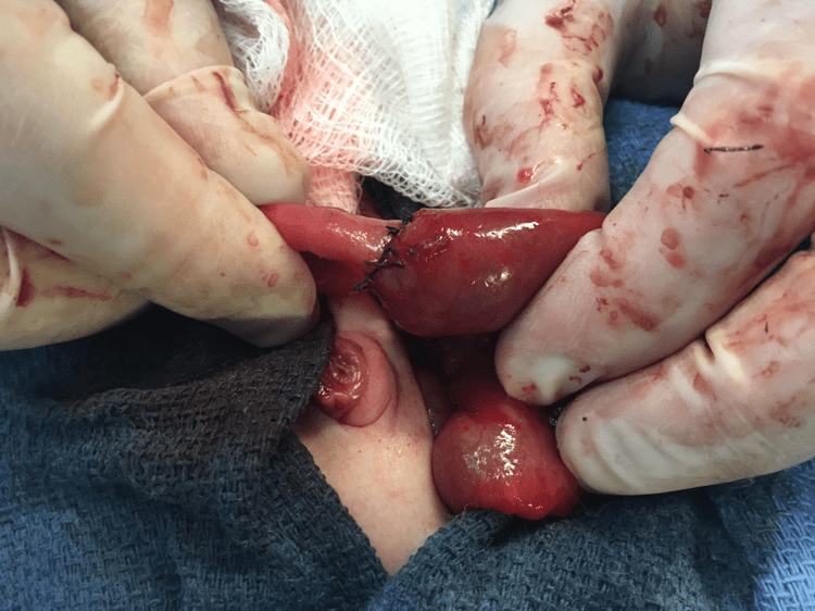 Image 6: Operative photo showing a Single Layer hand anastomosis 