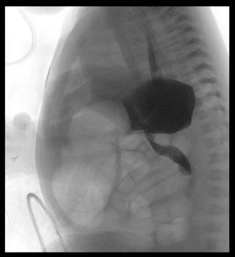 Image 3: Upper GI Series demonstrating a proximal intestinal obstruction