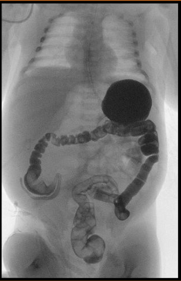 Image 4: Contrast Enema demonstrating a patent rectum and colon