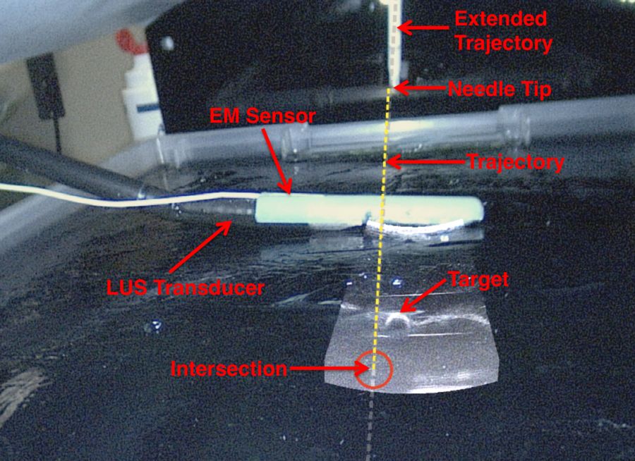 Figure 1. A snapshot of laparoscopic video showing the AR overlay with LUS image and the radiofrequency ablation needle trajectory.