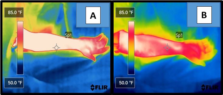 Figure 1. Thermal images of upper extremities in the field care setting prior to tourniquet tightening (A) and after tourniquet vascular occlusion (B)