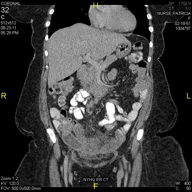 A/P CT Scan