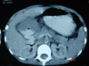 CT scan image -Intussusception