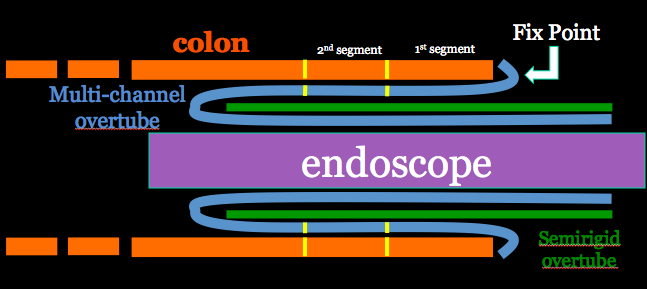 Fig.1 Outline of multi-channel shape-locking overtube system inside colon