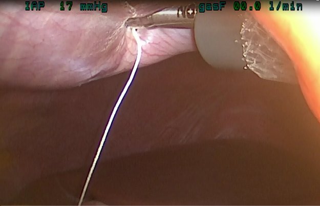 Device deploying anchor in abdominal wall