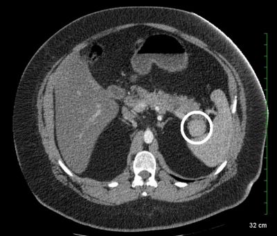 Abdominal CT scan showing Pancreatic Tumor