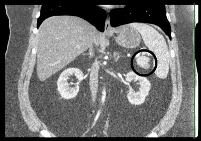 Abdominal CT scan Coronal view of Pancreatic Tumor