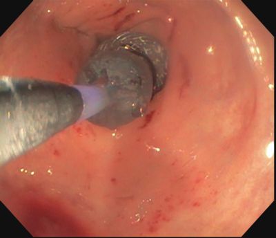 endoscopic placement of the Axios stent