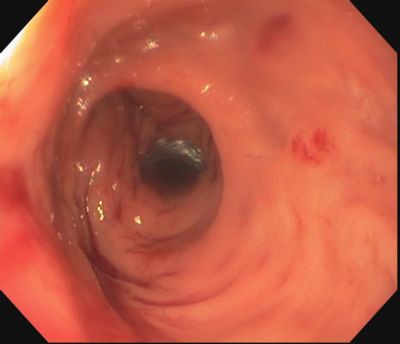 endoscopic view of stent in place
