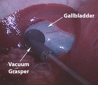 Laparoscopic testing of vacuum grasper