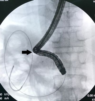 Fig: A SG guidewire was replaced. Acute angle of jejunal segment shown by arrow.