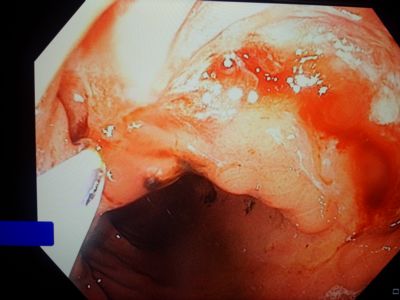 Figure 2: Endoscopic view of gastric conduit with wire through fistula