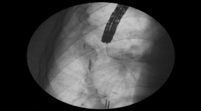 Figure 3: Fluoroscopic view of wire placement through the fistula