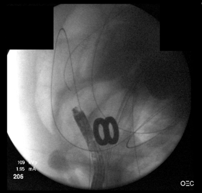 Image 1. Fluoroscopy showing mated magnets