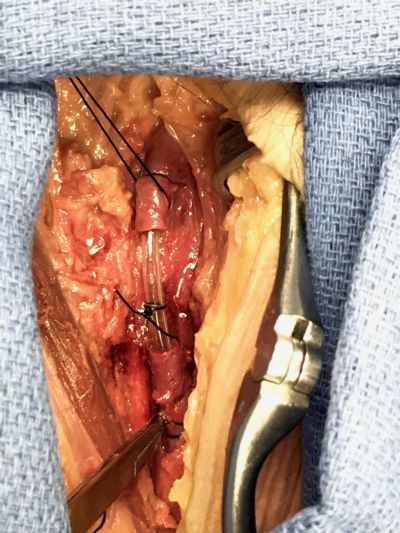 Image 1. Dissection performed during workshop of femoral artery with intravascular shunt in place.