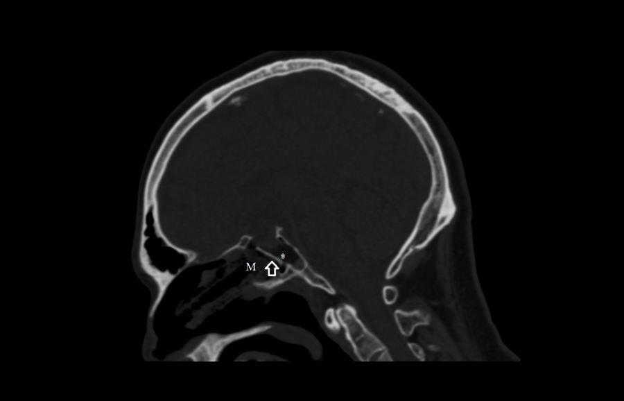 Fig 3 - Sagittal CT showing placement of the buttress and bone graft
